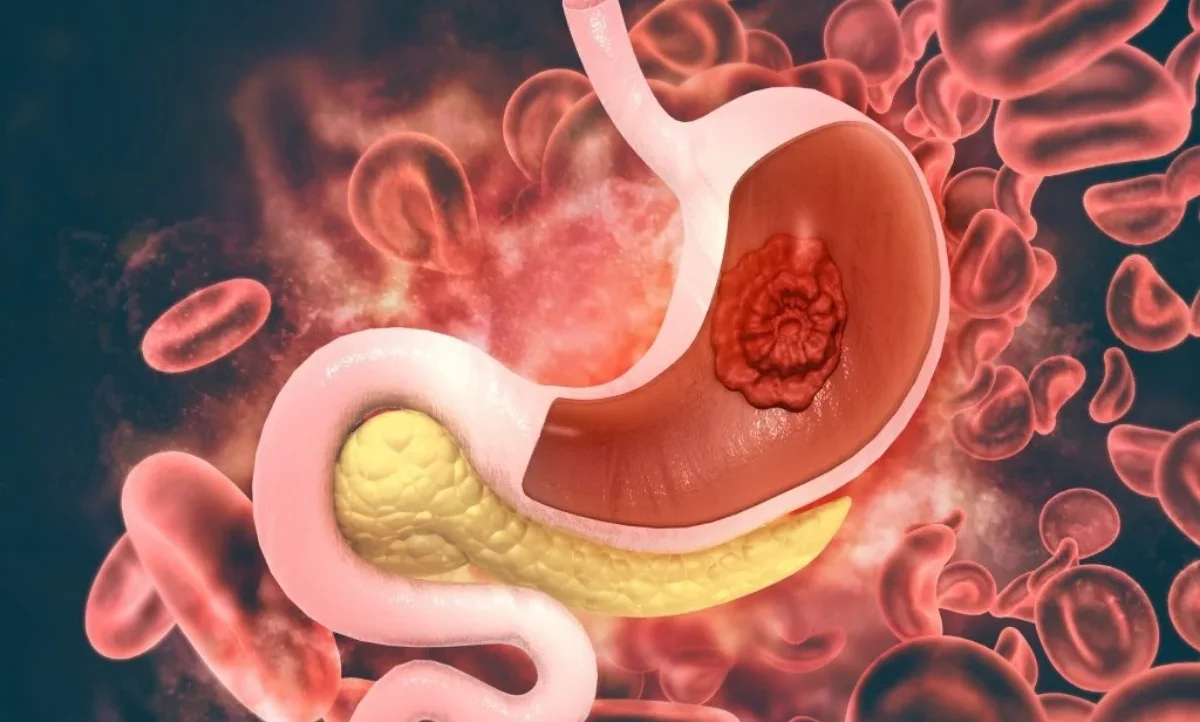 Stomach Cancer
