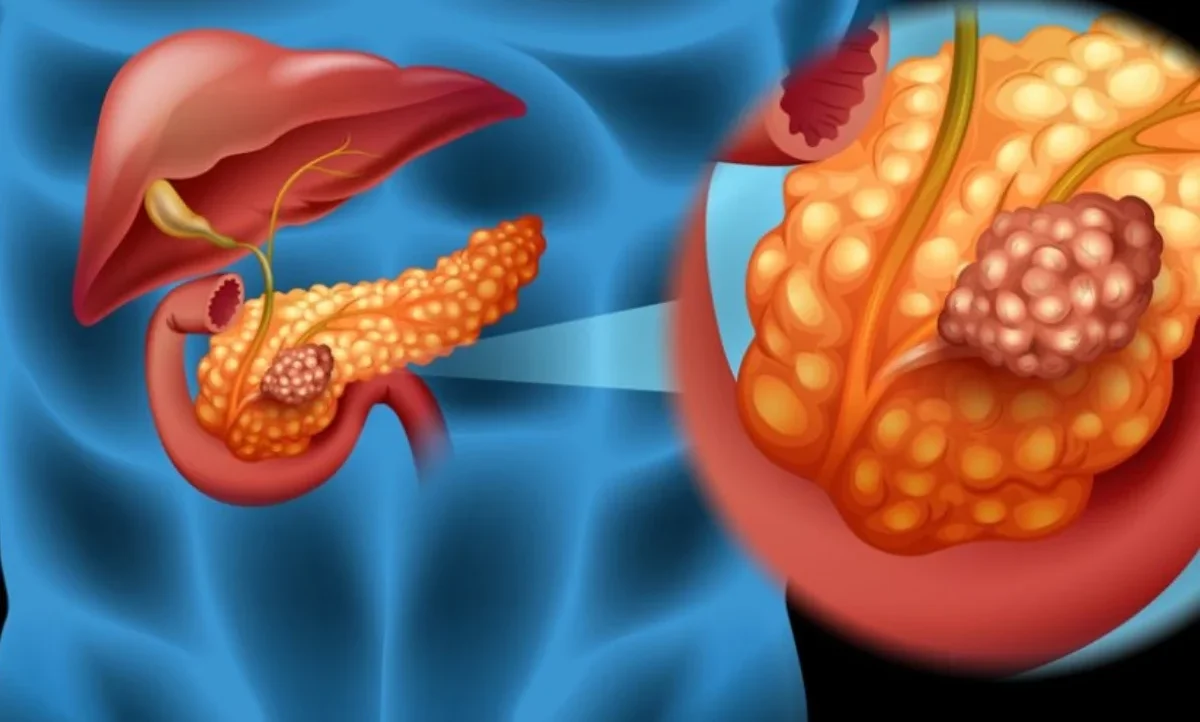 Pancreas Cancer