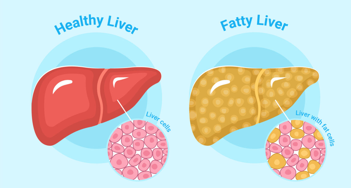 Understanding the fatty liver (NALFLD)