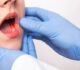 Comprehensive Oral Cancer Treatment in Ahmedabad at Airavat Cancer Care
