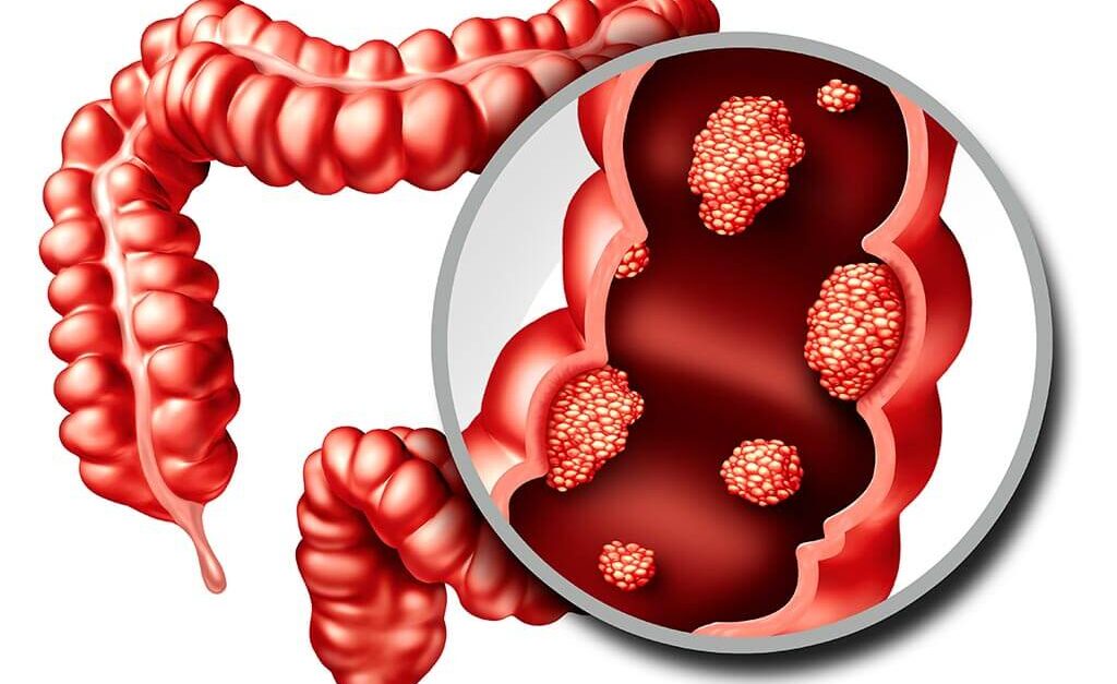 Colon Cancer Treatment in Ahmedabad
