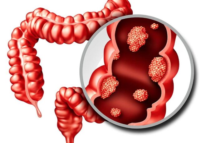 Colon Cancer Treatment in Ahmedabad