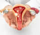 Early Signs of Gynecologic Cancer You Shouldn’t Ignore