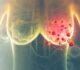 What Every Woman Should Know About Breast Cancer?