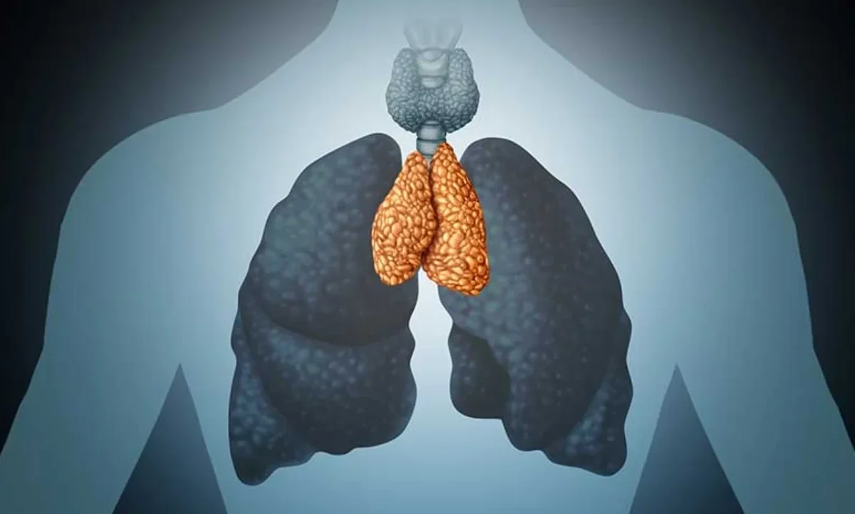 Thymoma Cancer