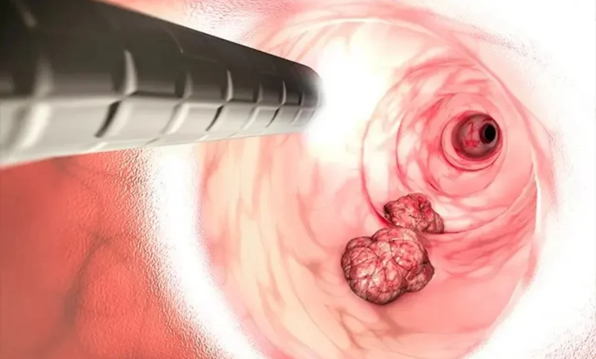 Rectal Cancer