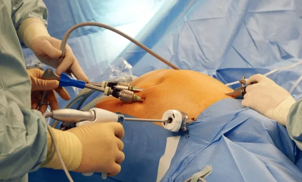 HIPEC Treatment