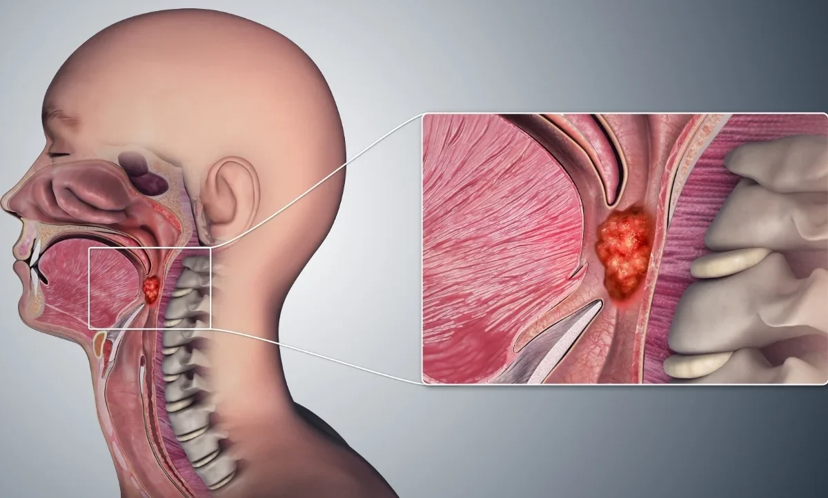 Pharynx Cancer Treatment