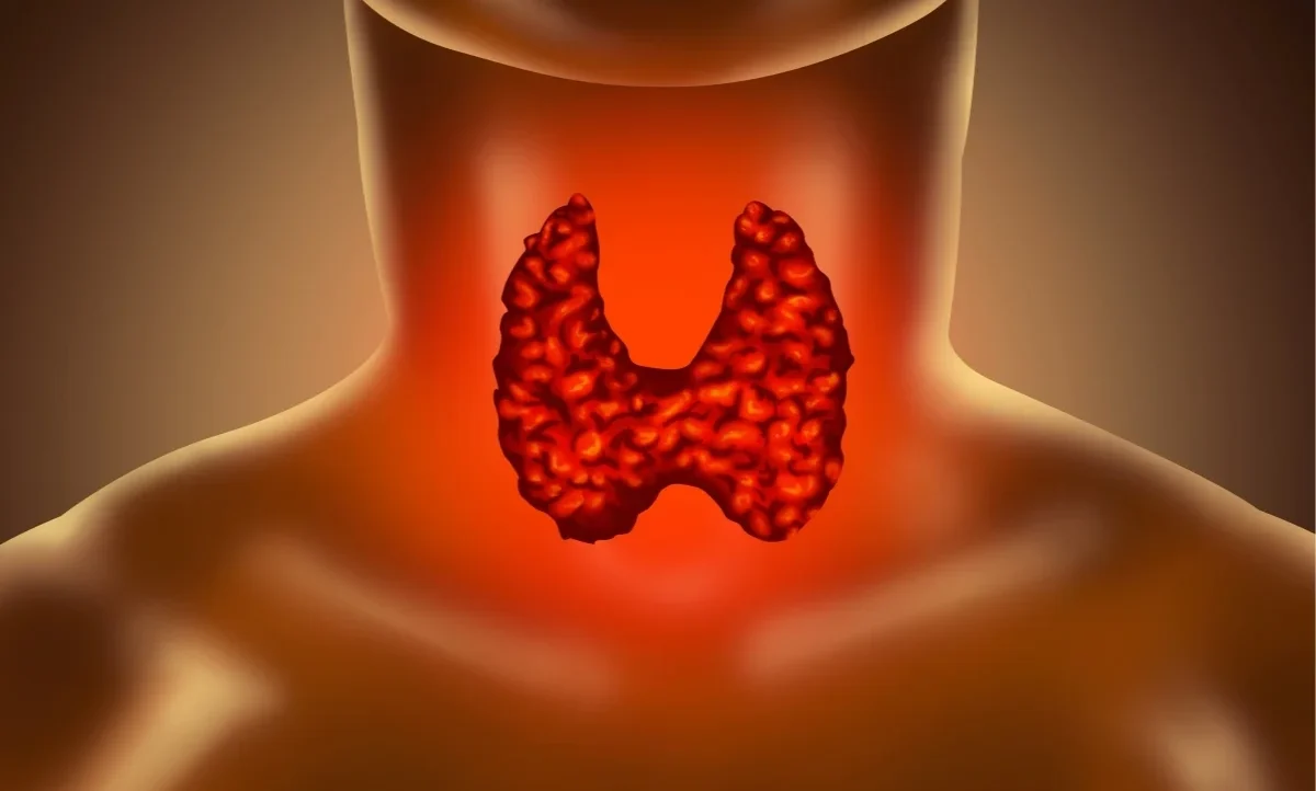 Parathyroid Cancer