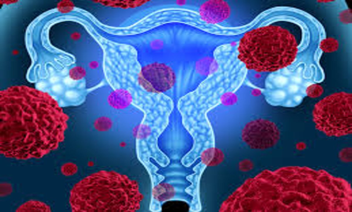 Surgery for Endometrial Cancer (1)