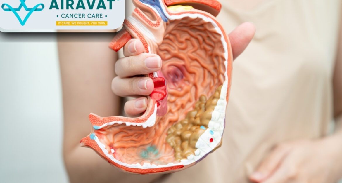 Stomach Cancer